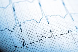 Elektrokardiogram yang menunjukkan denyut jantung manusia